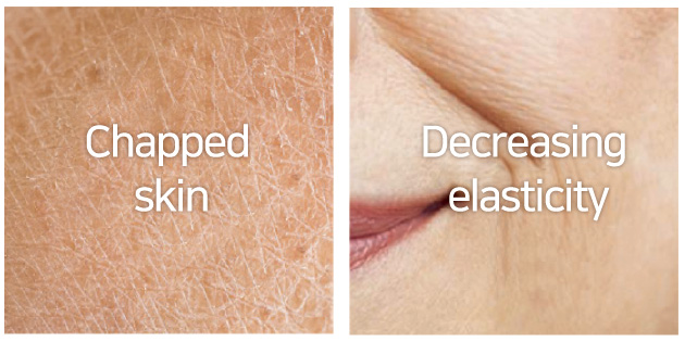 Chapped skin, Decreasing elasticity